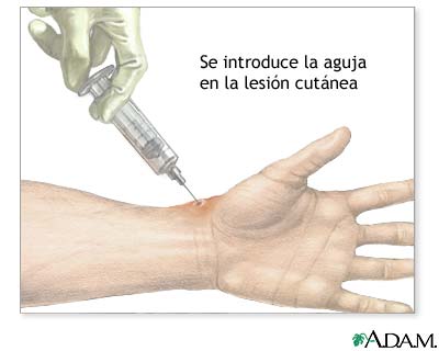 Aspiraci&oacute;n de una lesi&oacute;n de piel