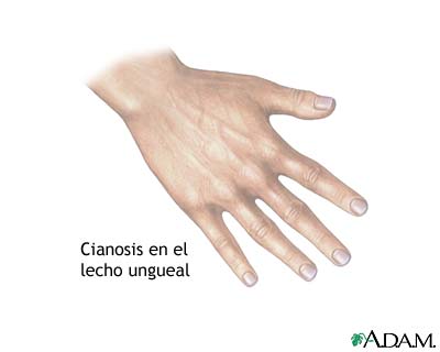 Cianosis del lecho de la u&ntilde;a