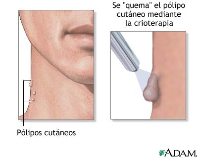 Excrecencia cut&aacute;nea