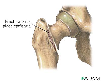 Fractura femoral