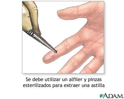 Extracci&oacute;n de una astilla