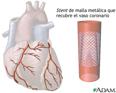 Stent de arteria coronaria