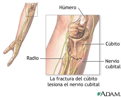 Da&ntilde;o del nervio cubital