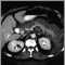 Pancreatitis aguda; TC