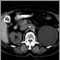 Quiste renal con c&aacute;lculos biliares; TC