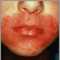 Candidiasis cut&aacute;nea alrededor de la boca