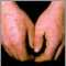 Eritema multiforme en las manos