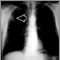 Masa pulmonar, pulm&oacute;n superior derecho - Radiograf&iacute;a de t&oacute;rax