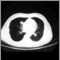N&oacute;dulo pulmonar, pulm&oacute;n inferior derecho - Tomograf&iacute;a computarizada