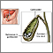 Colelitiasis