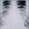 Pulmon&iacute;a aguda por varicela - Rayos X de t&oacute;rax