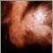 Foliculitis descalvante en el cuero cabelludo
