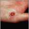 Granuloma piog&eacute;nico en la mano