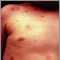 Urticaria pigmentosa en el t&oacute;rax