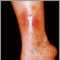 Dermatitis por estasis en la pierna