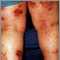 Dermatitis at&oacute;pica de las piernas