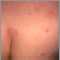 Urticaria en espalda y gl&uacute;teos