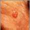 Carcinoma de c&eacute;lula basal en la cara